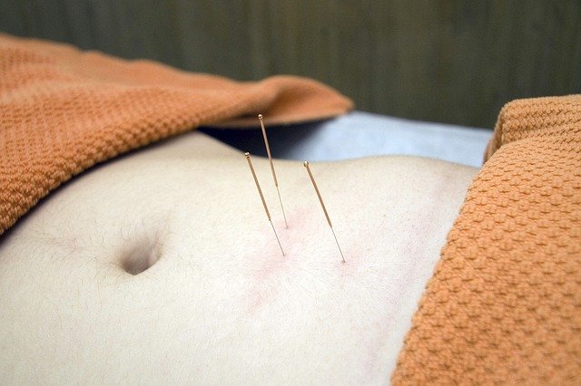 acupuncture